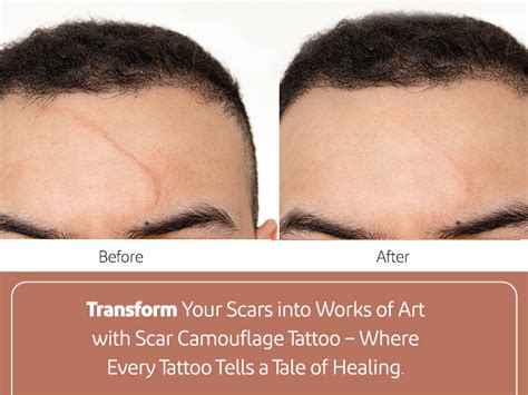 Tummy Tuck Scar Tattoo: Transforming Marks into Art